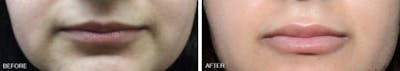 Injectables before and after, frontal.