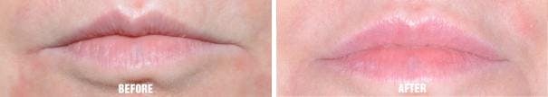 Injectables before and after, frontal.
