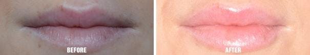 Injectables before and after, frontal.