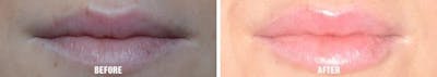 Injectables before and after, frontal.