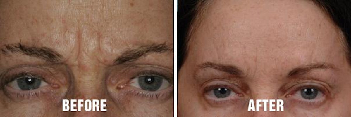 Injectables before and after, frontal.