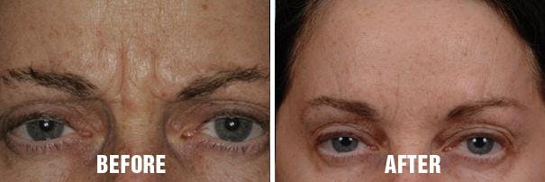 Injectables before and after, frontal.