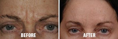 Injectables before and after, frontal.