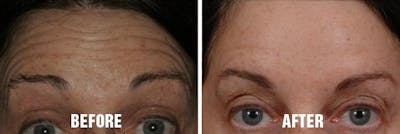 Injectables before and after, frontal.