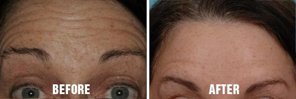 Injectables before and after, frontal.