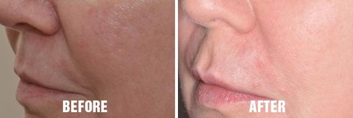Injectables before and after, oblique left.