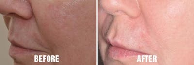 Injectables before and after, oblique left.