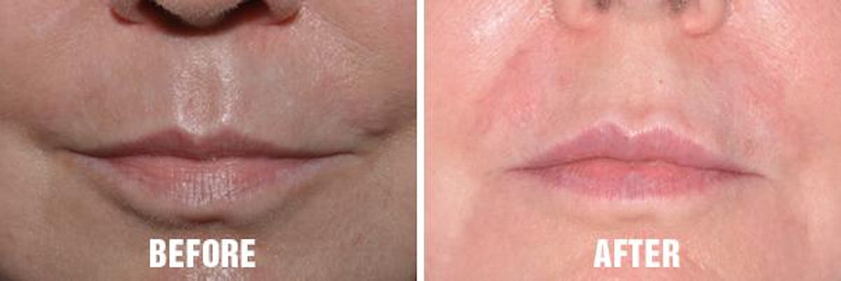 Injectables before and after, frontal.