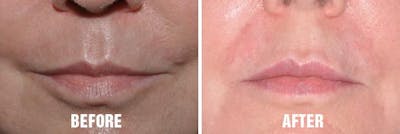 Injectables before and after, frontal.