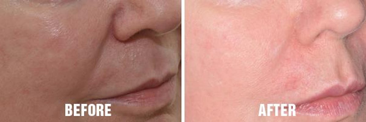 Injectables before and after, oblique right.