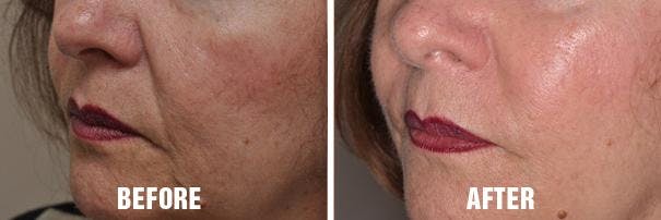 Injectables before and after, oblique left.