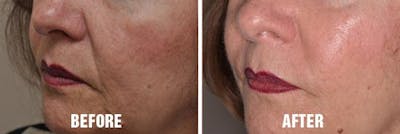 Injectables before and after, oblique left.