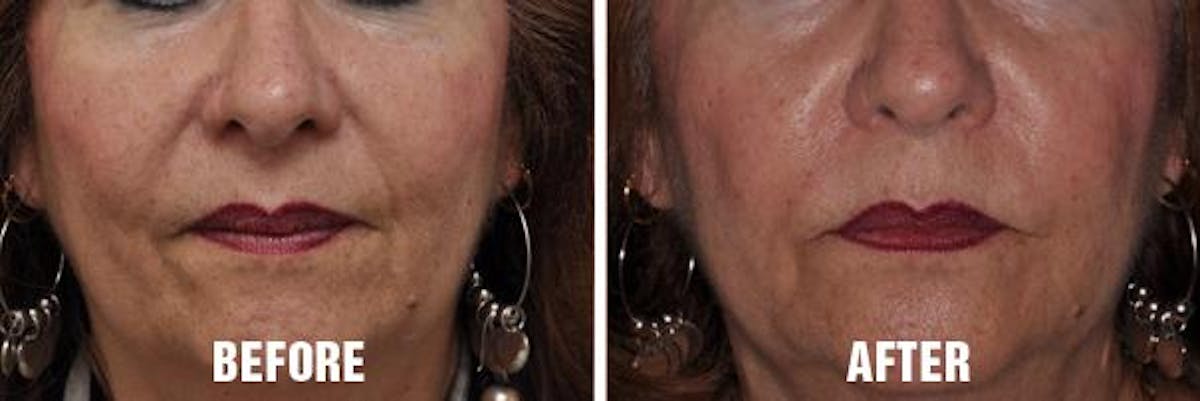 Injectables before and after, frontal.