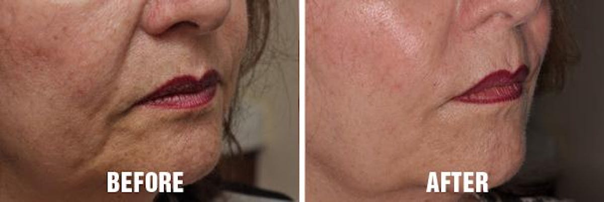Injectables before and after, oblique right.