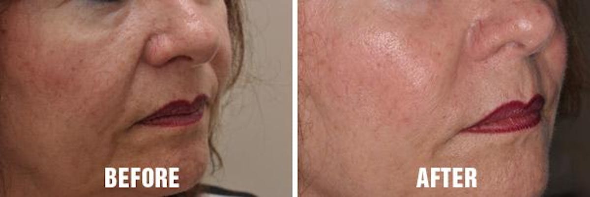 Injectables before and after, oblique right.