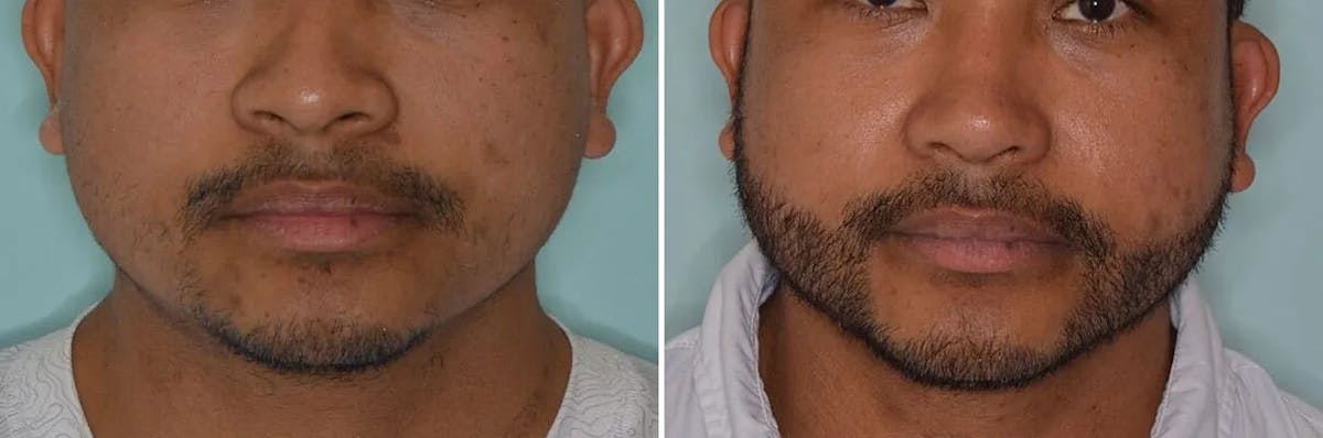 Beard Transplant before and after, frontal.