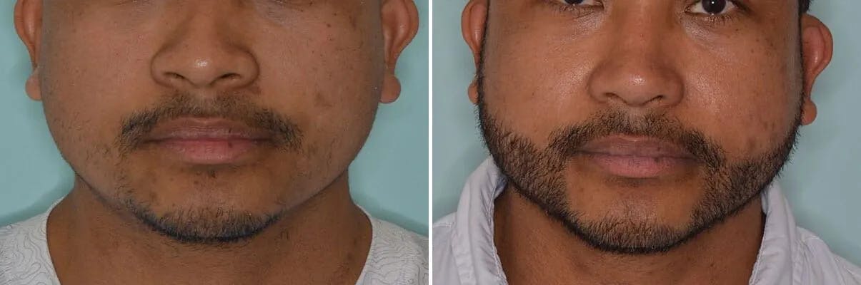 Beard Transplant before and after, frontal.