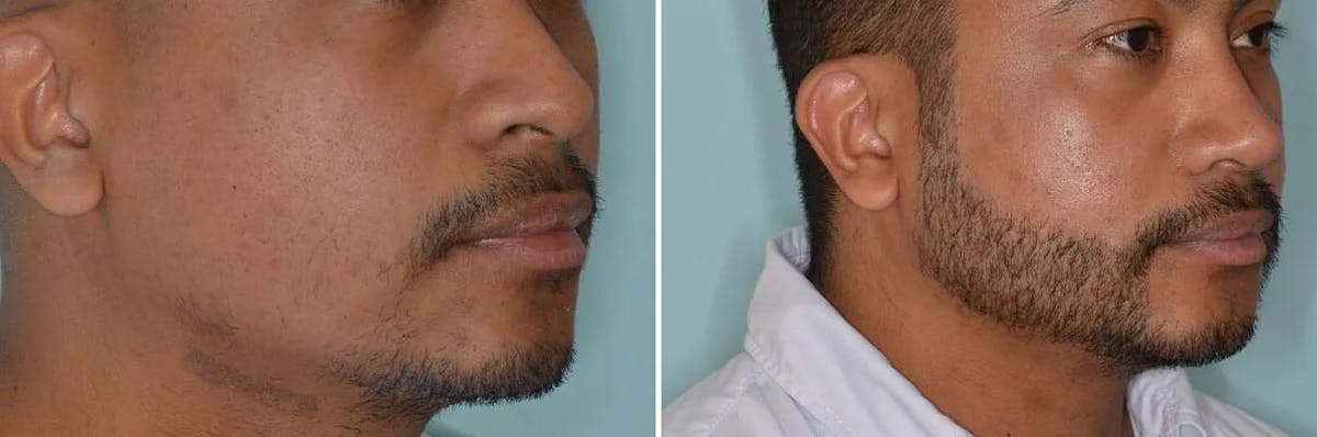 Beard Transplant before and after, lateral right.