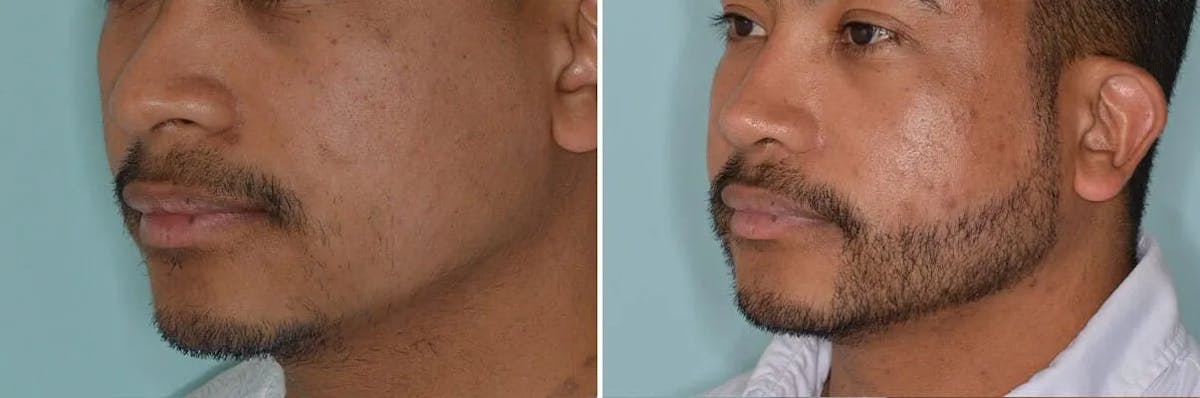 Beard Transplant before and after, lateral left.