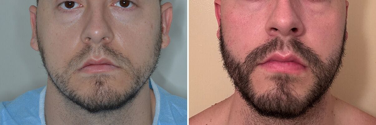 Beard Transplant before and after, frontal.