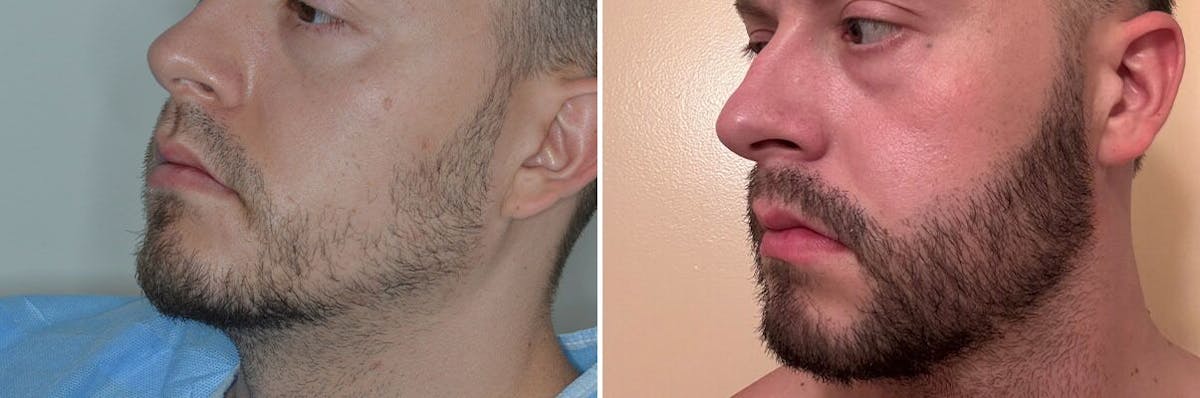 Beard Transplant before and after, lateral left.