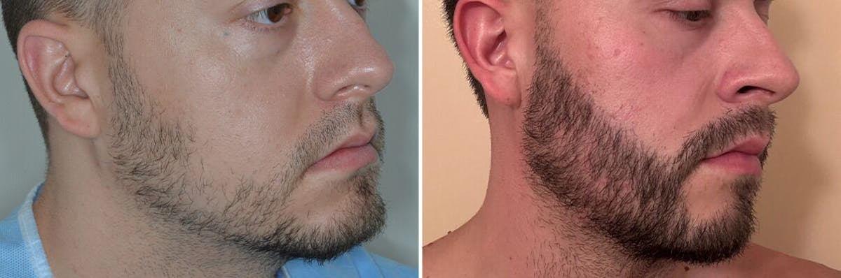 Beard Transplant before and after, lateral right.