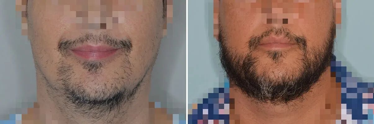 Beard Transplant before and after, frontal.