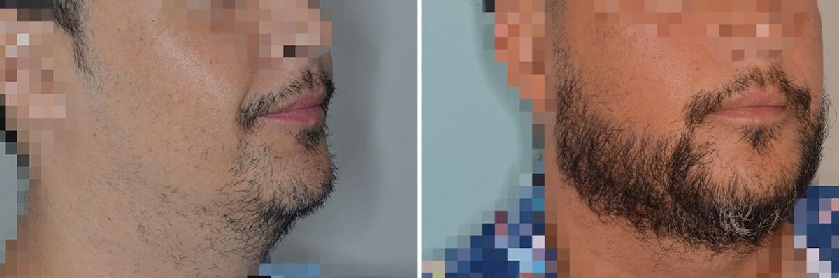Beard Transplant before and after, lateral right.