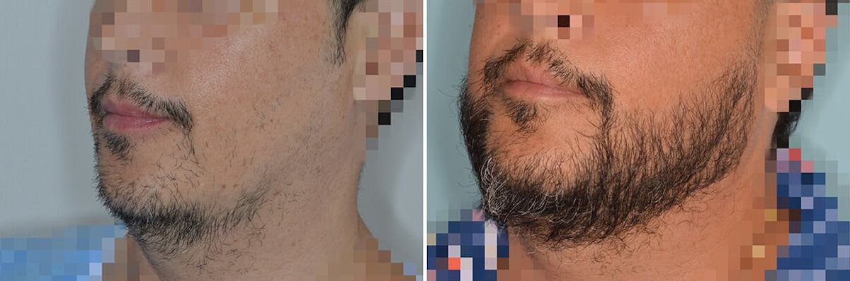 Beard Transplant before and after, lateral left.
