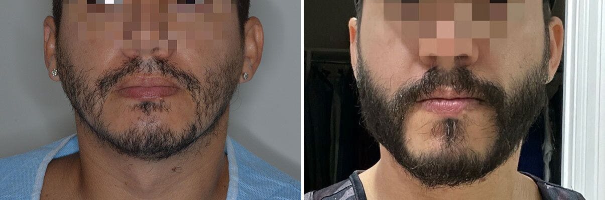 Beard Transplant before and after, frontal.