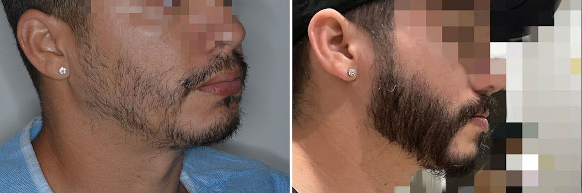 Beard Transplant before and after, lateral right.