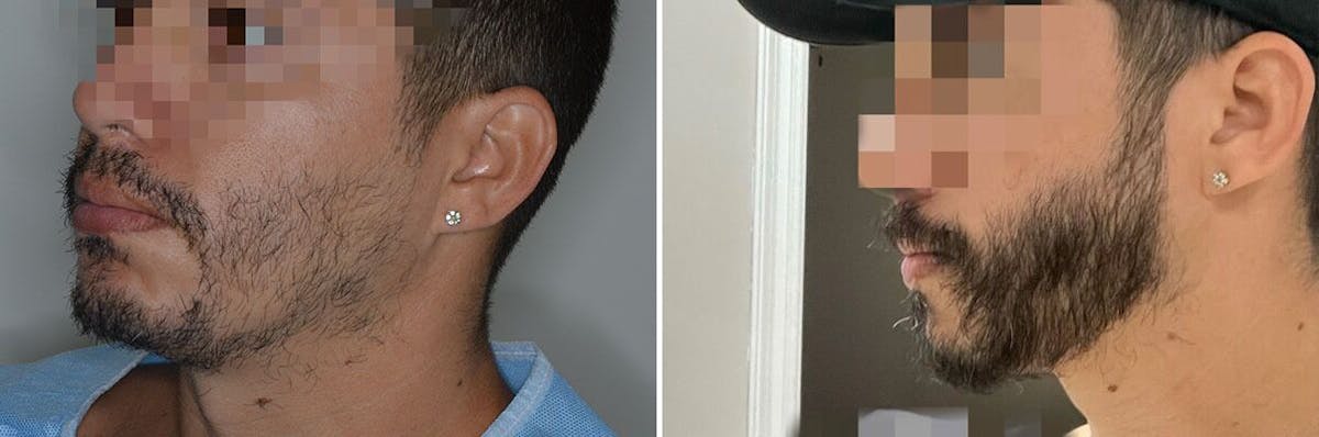 Beard Transplant before and after, lateral left.