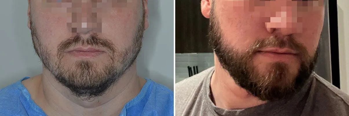 Beard Transplant before and after, frontal.