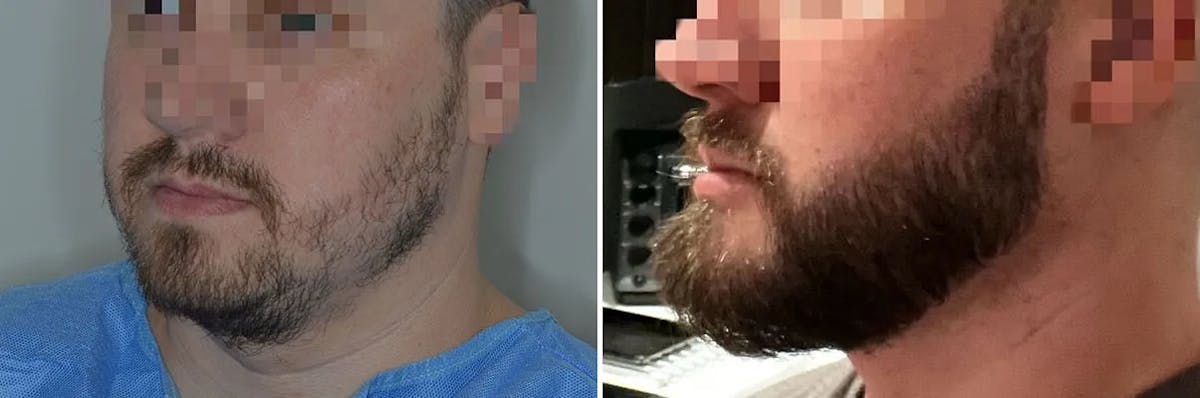 Beard Transplant before and after, lateral left.