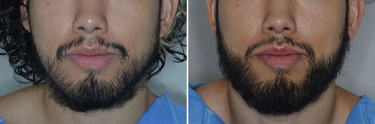 Beard Transplant before and after, frontal.