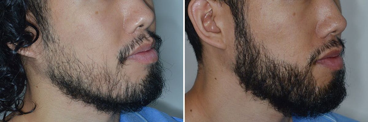 Beard Transplant before and after, oblique right.