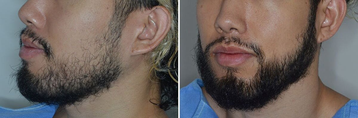 Beard Transplant before and after, oblique left.