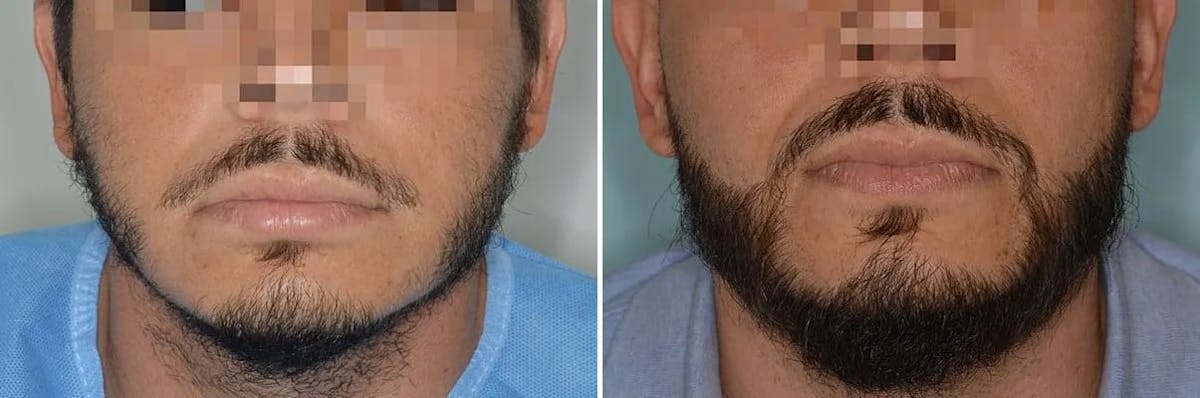 Beard Transplant before and after, frontal.