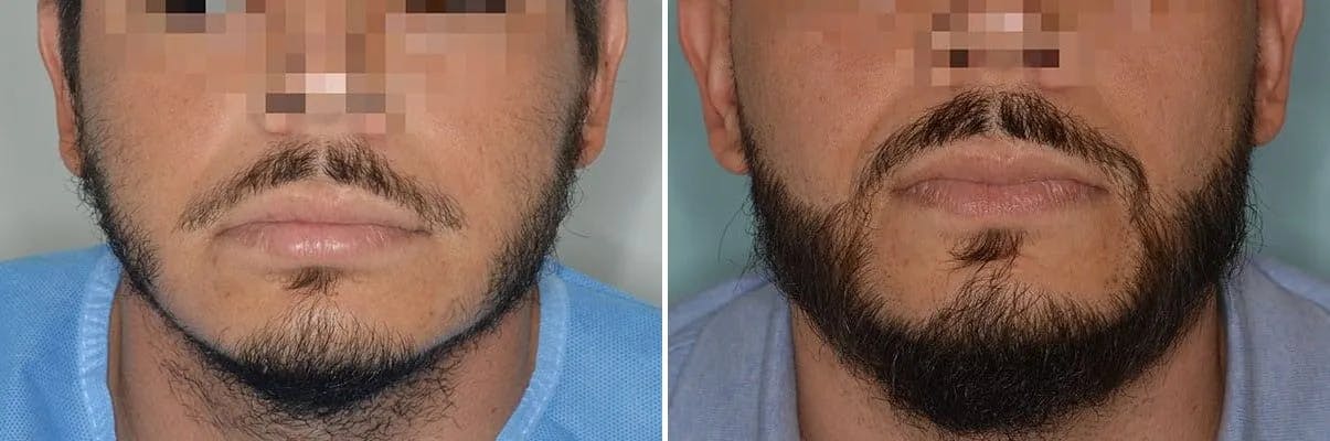 Beard Transplant before and after, frontal.