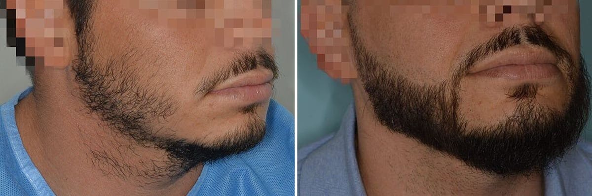 Beard Transplant before and after, oblique right.