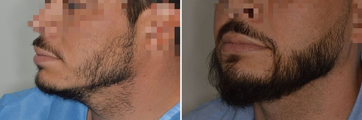 Beard Transplant before and after, oblique left.
