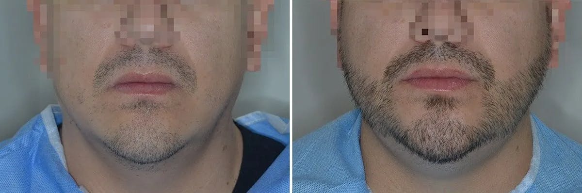 Beard Transplant before and after, frontal.