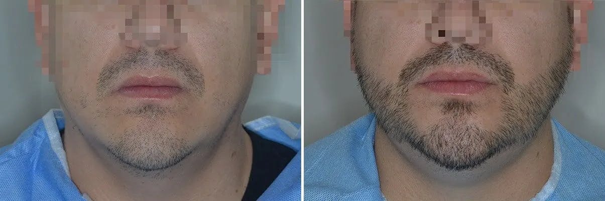 Beard Transplant before and after, frontal.