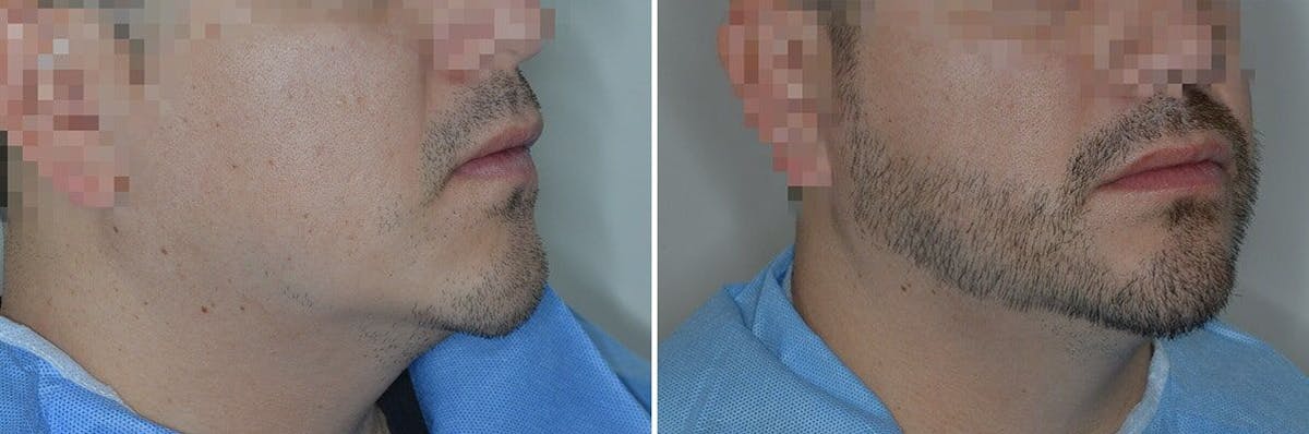 Beard Transplant before and after, oblique right.