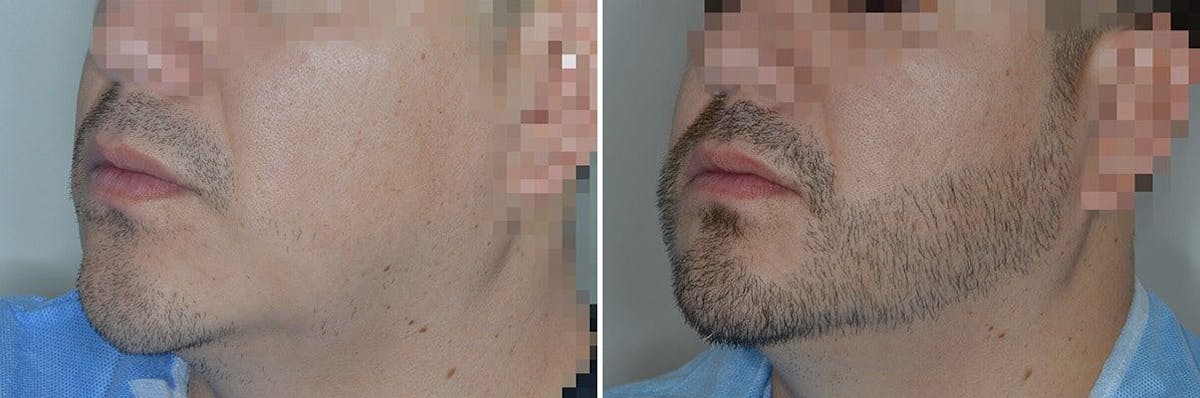 Beard Transplant before and after, oblique left.