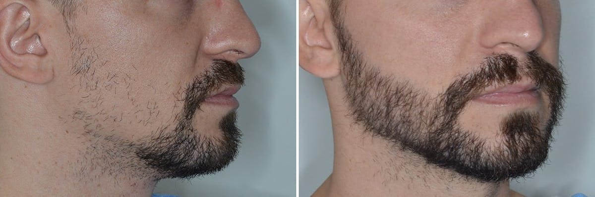 Beard Transplant before and after, oblique right.