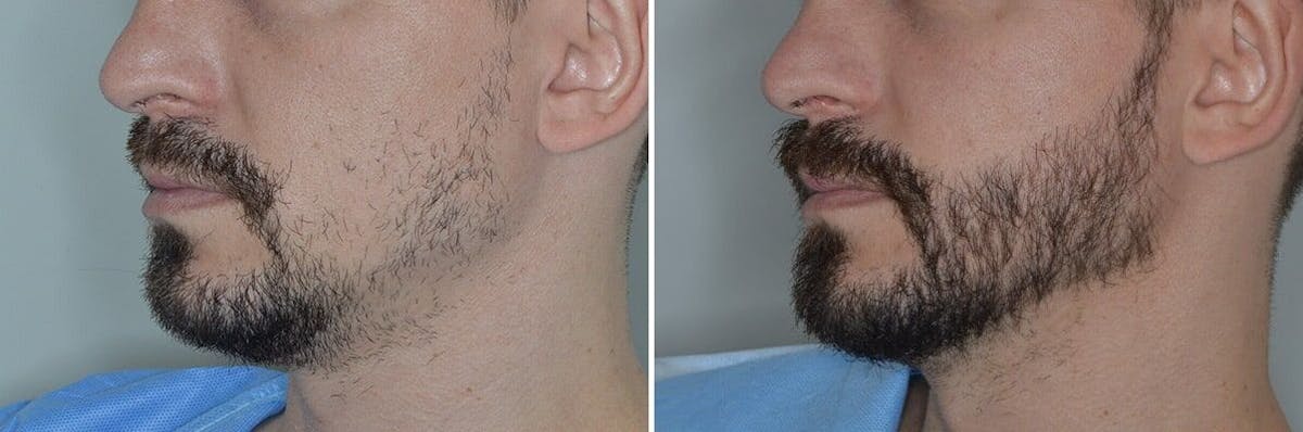 Beard Transplant before and after, oblique left.
