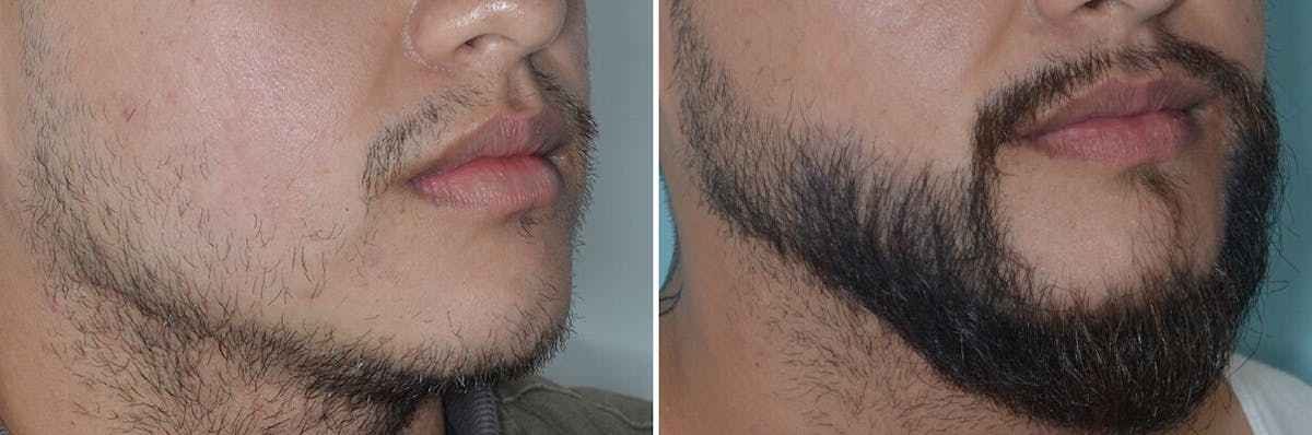 Beard Transplant before and after, oblique right.