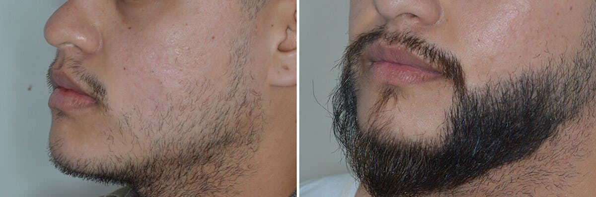 Beard Transplant before and after, oblique left.