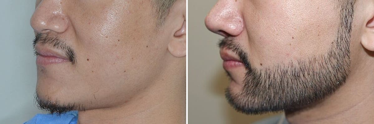 Beard Transplant before and after, lateral left.